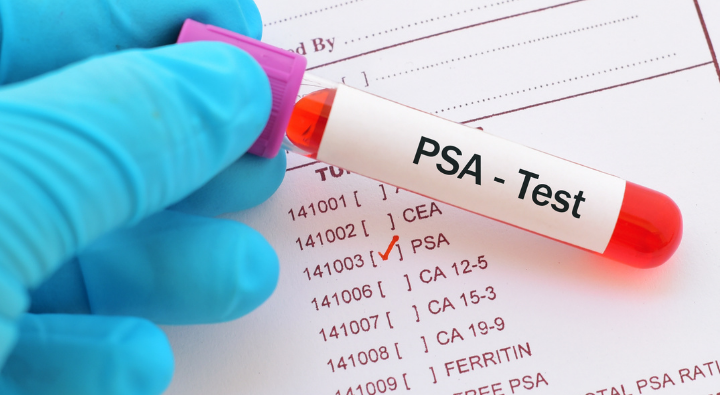 PSA teszt, prosztata-monitorozás, prosztataspecifikus antigén, prosztata rák, prosztata gyulladás, rákszűrés
